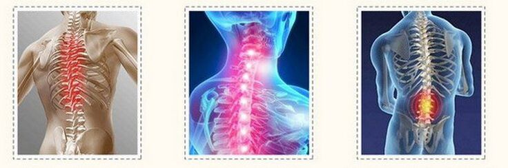 Skirtingo stuburo osteochondrozė
