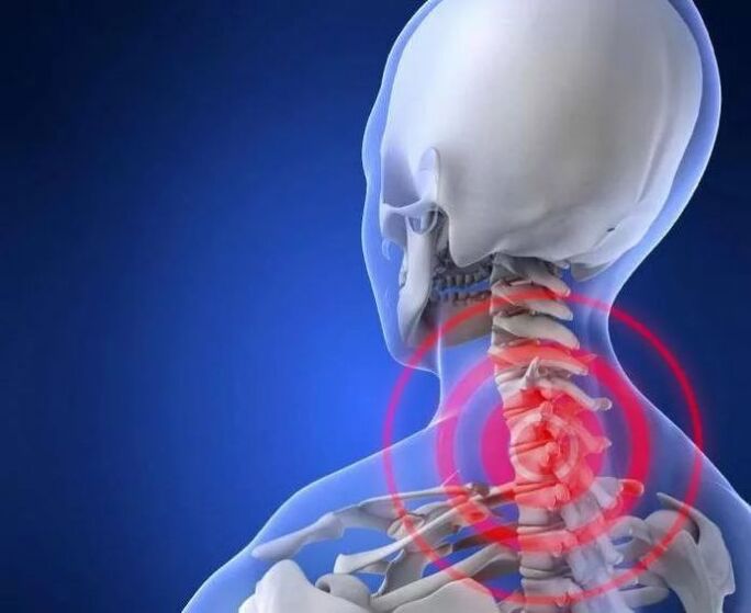Kas yra osteochondrozė
