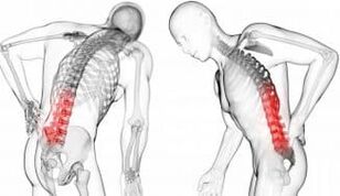 Tarpslankstelinė išvarža - komplikacija su osteochondroze