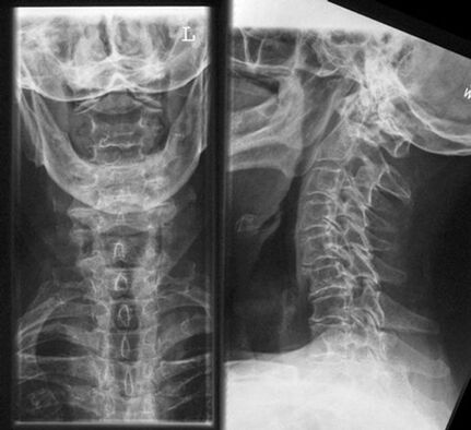 Gimdos kaklelio x -ray - osteochondrozės diagnozės metodas