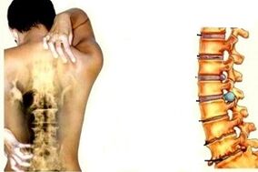 Nugaros skausmas skirtinguose gimdos kaklelio osteochondrozės vystymosi etapuose