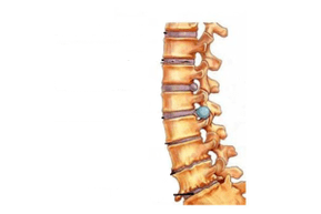 Stuburo pažeidimas naudojant gimdos kaklelio osteochondrozę