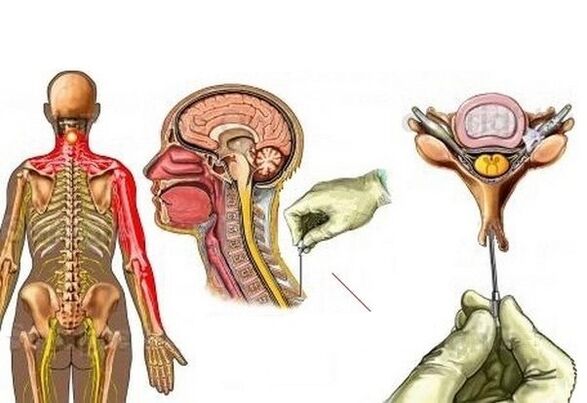 Gimdos kaklelio osteochondrozės gydymas akupunktūra