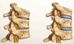 Kaip atrodo osteochondrozė