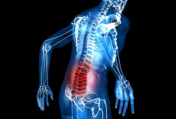 Kas yra juosmens osteochondrozė