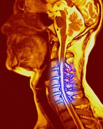 Gimdos kaklelio chondrozė