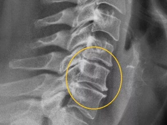 Gimdos kaklelio stuburo osteochondrozė rentgeno spinduliuose